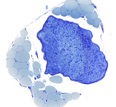 Microscopic cross-section through a peripheral nerve bundle (dark blue), which contains hundreds of nerve fibers coated with Schwann cells. Numerous large fat cells (light blue) can be seen in the vicinity of the nerve. Microscopic cross-section through a peripheral nerve bundle (dark blue), which contains hundreds of nerve fibers coated with Schwann cells. Numerous large fat cells (light blue) can be seen in the vicinity of the nerve. Photo: Leipzig University