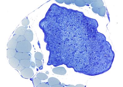 Microscopic cross-section through a peripheral nerve bundle (dark blue), which contains hundreds of nerve fibers coated with Schwann cells. Numerous large fat cells (light blue) can be seen in the vicinity of the nerve. Microscopic cross-section through a peripheral nerve bundle (dark blue), which contains hundreds of nerve fibers coated with Schwann cells. Numerous large fat cells (light blue) can be seen in the vicinity of the nerve. Photo: Leipzig University