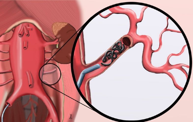 In dieser Form werden ausgewählte Segmentarterien mithilfe sogenannter Coils verschlossen.