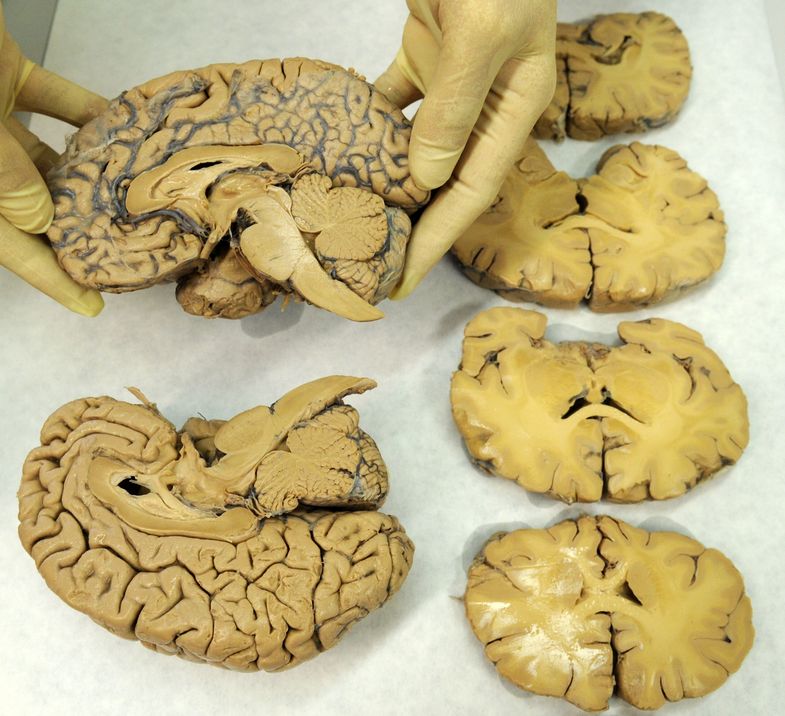 Brain slices of Alzheimer patients