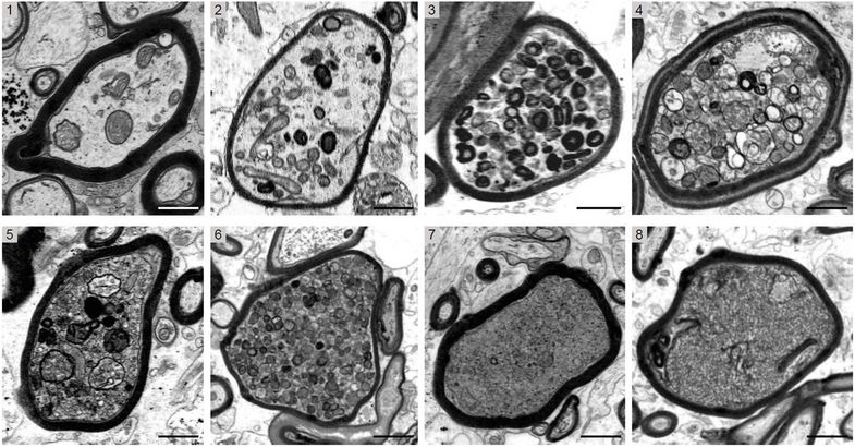 Die Bilderserie zeigt elektronenmikroskopische Aufnahmen einzelner Nervenfasern in MS Hirnbiopsien im Querschnitt. Zu sehen sind mit Myelin (schwarze Ringe) ummantelte Axone, die von 1 bis 8 zunehmend starke Schädigungen aufweisen. Das Spektrum reicht dabei von der Anreicherung einzelner Zellbestandteile in sonst noch hellen, intakten Axonen (1) bis hin zur fortgeschrittenen Degeneration in dunklen irreversibel geschädigten Axonen (8).