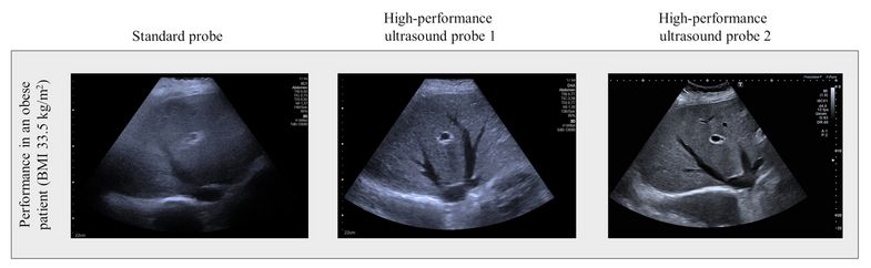 Bearbeitete Abbildung aus der Publikation: Untersuchung der Leber eines adipösen Patienten. Die Bildqualität der herkömmlichen Ultraschallsonde (links) ist deutlich schlechter als bei den Hochleistungssonden (Mitte und links).