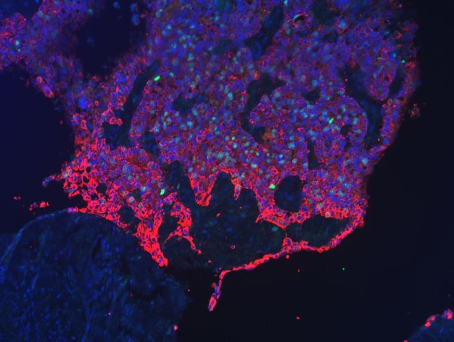 Fluorescence image of a tumour front of the cervix. Cell nuclei are shown in blue and dividing cells in green. Tumour cells, marked in red, infiltrate and suppress healthy tissue. Photo: Leipzig University Hospital