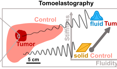 Image: Frank Sauer / Leipzig University Tumour-associated microscopic effects such as the liquification or increased fluidity of cancer cells have an effect on the tumour’s macroscopic mechanical properties. These can then be measured directly in a patient’s body using tomoelastography.