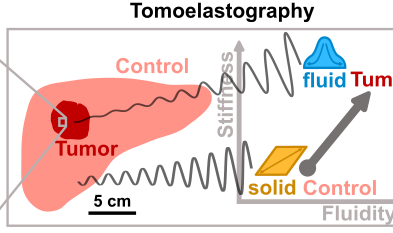 Tumour-associated microscopic effects such as the liquification or increased fluidity of cancer cells have an effect on the tumour’s macroscopic mechanical properties. These can then be measured directly in a patient’s body using tomoelastography.