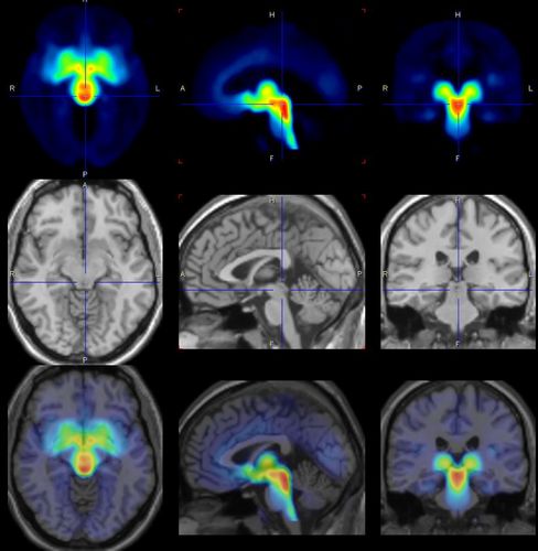 Die Wissenschaftler:innen haben zu verschiedenen Zykluszeitpunkten mit Positronen-Emissions-Tomografie (PET) Aufnahmen vom Gehirn der Frauen gemacht. Abbildung: MPI CBS