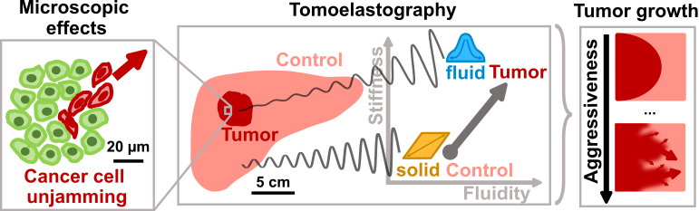 Tumour-associated microscopic effects such as the liquification or increased fluidity of cancer cells have an effect on the tumour’s macroscopic mechanical properties. These can then be measured directly in a patient’s body using tomoelastography.
